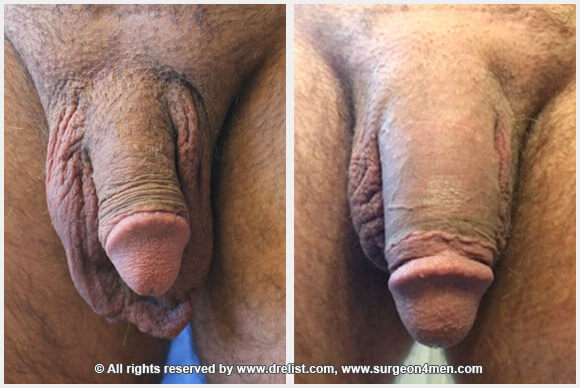 Penis Enlargement Before & After Image