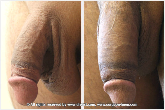 Penis Enlargement Before & After Image