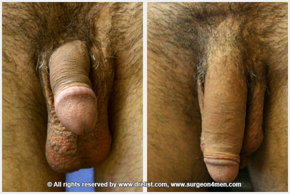 Penis Enlargement Before & After Image