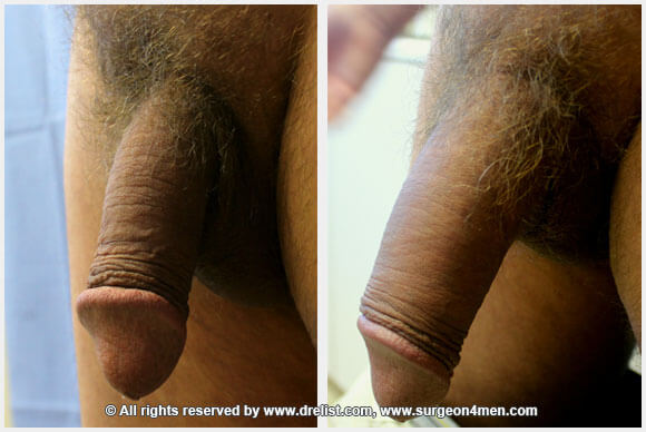 Penis Enlargement Before & After Image