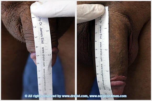 Penis Enlargement Before & After Image
