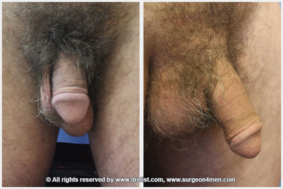 Penis Enlargement Before & After Image