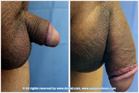 Penis Enlargement Before & After Image