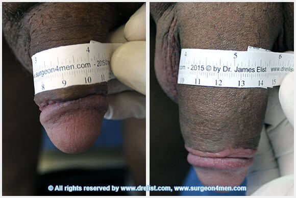 Penis Enlargement Before & After Image
