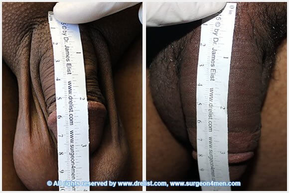 Penis Enlargement Before & After Image