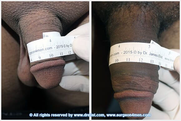Penis Enlargement Before & After Image