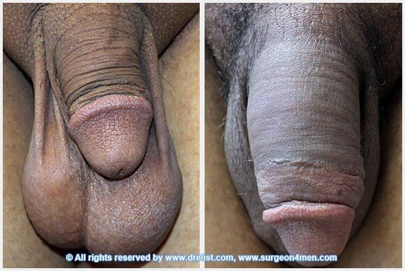 Penis Enlargement Before & After Image