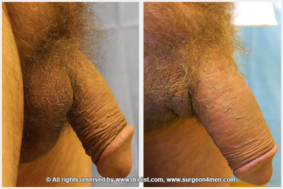Penis Enlargement Before & After Image