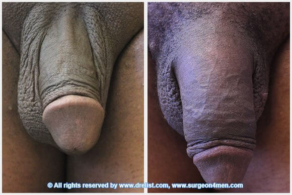 Penis Enlargement Before & After Image