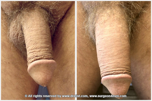 Penis Enlargement Before & After Image