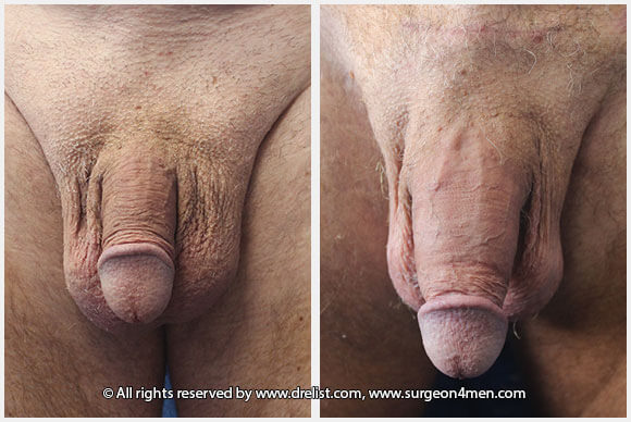Penis Enlargement Before & After Image