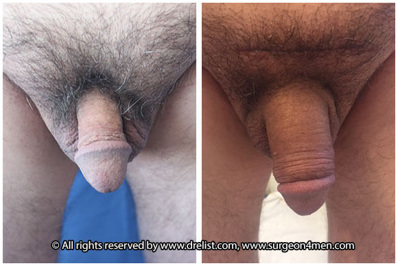 Penis Enlargement Before & After Image