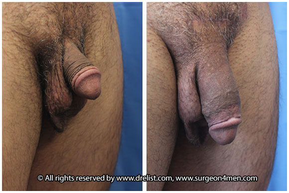 Penis Enlargement Before & After Image
