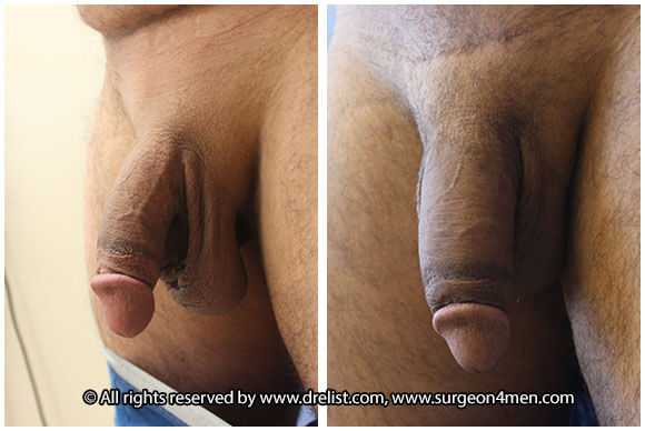 Penis Enlargement Before & After Image