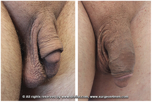 Penis Enlargement Before & After Image