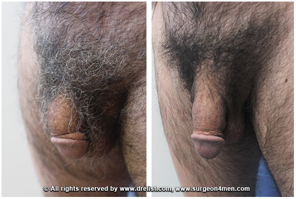 Penis Enlargement Before & After Image