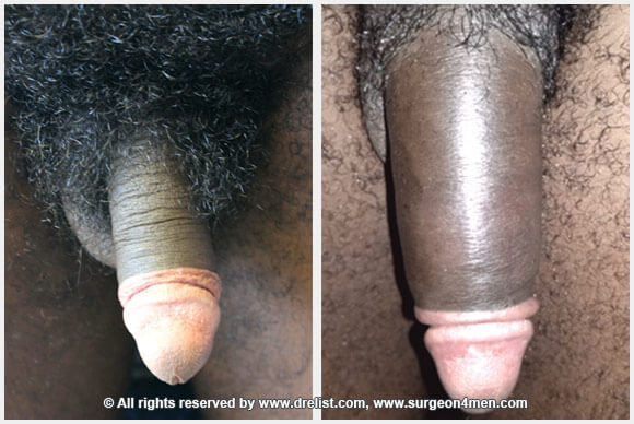 Penis Enlargement Before & After Image