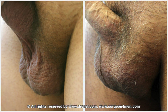 Testicular Enlargement — Patient 2 — Before & After