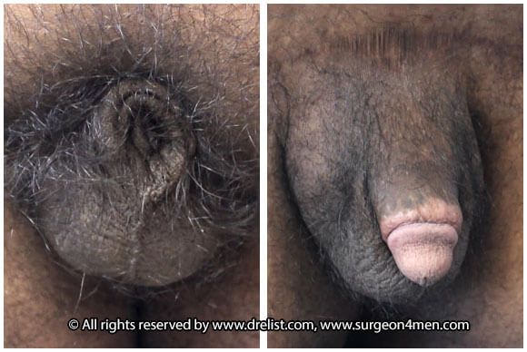 Buried Penis — Patient 8 — Before & After