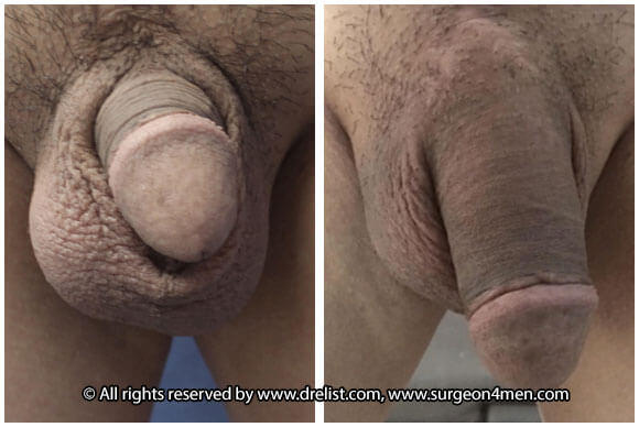 Buried Penis — Patient 7 — Before & After