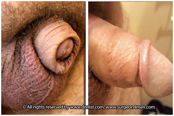 Buried Penis — Patient 6 — Before & After