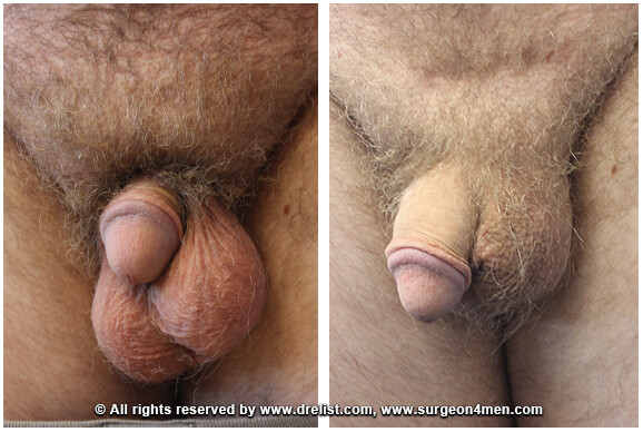 Buried Penis — Patient 4 — Before & After