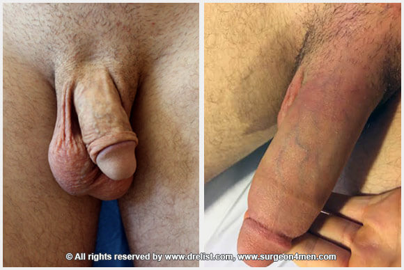 Erect Penis — Patient 1 — Before & After