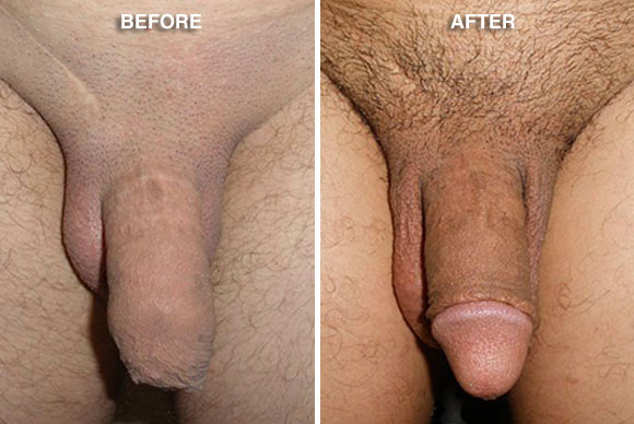 Circumcision Healing, Circumcision benefits, Circumcision Before After Photo
