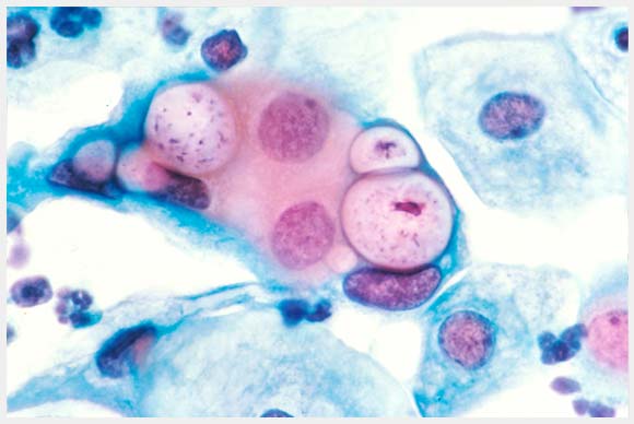 Facts About Chlamydia