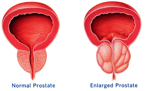 Enlarged Prostate - Prostate Disorders