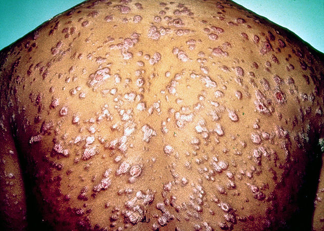 syphilis