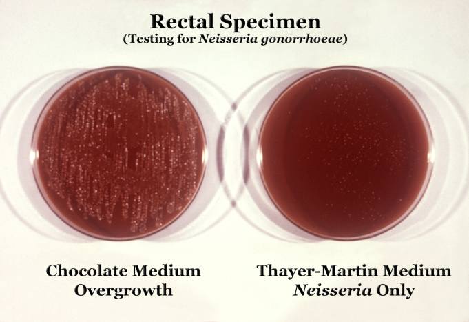 Gonorrhea Infection
