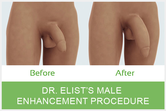 Penile Enlargement Procedure, Obamacare