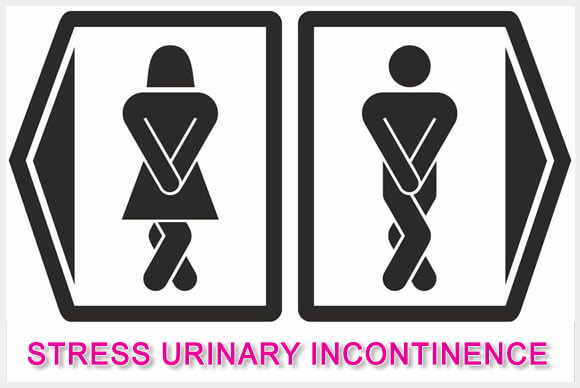 Best Treatments for Stress Urinary Incontinence