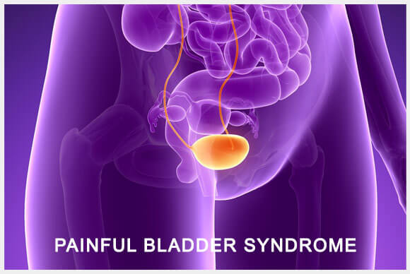 Painful Bladder Syndrome