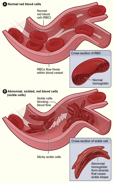 priapism causes, sickle cell anemia photo