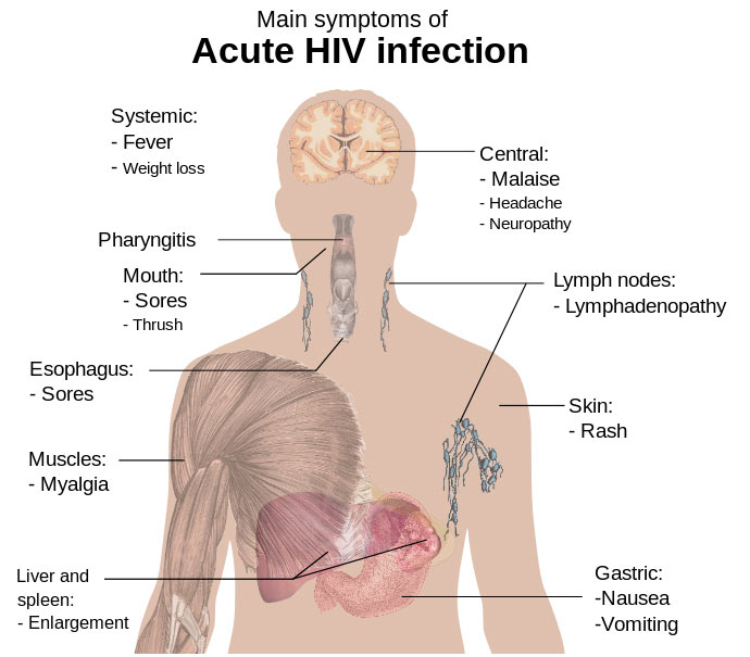 HIV Symptoms Image