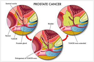 Prostate Cancer Screening