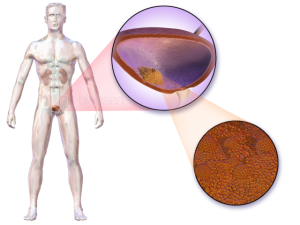 Blausen_0082_BladderCancer