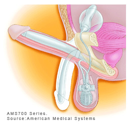 Penile Prosthesis Surgery for Erectile Dysfunction