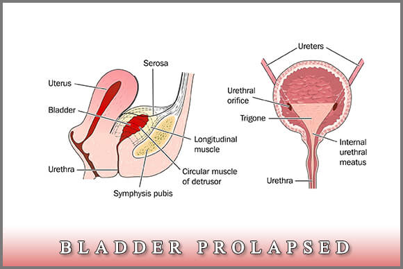 Bladder Prolapsed, All You Need To Know About