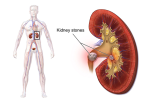 Urethral Stones Info.