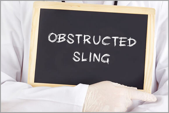 Obstructed Sling Causes and Sling Types