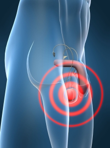 Hypogonadism