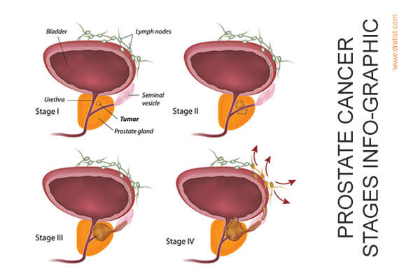 Prostate Cancer Stages Info-Graphics