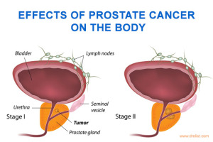 Effects of Prostate Cancer on Body Image
