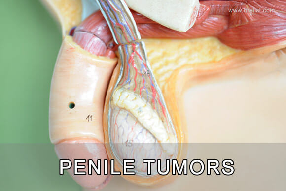 Penile Tumors | Penile Cancer | Causes, Diagnosis and Treatment
