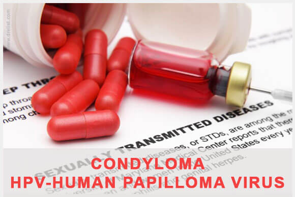 CONDYLOMA (HPV-Human Papilloma Virus)