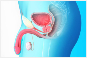 Prostate Treatment