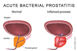 Acute Bacterial Prostatitis Image